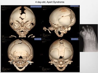 4 day-old, Apert Syndrome
 