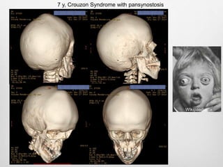 7 y, Crouzon Syndrome with pansynostosis
Wikipaedia
 