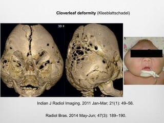 Indian J Radiol Imaging. 2011 Jan-Mar; 21(1): 49–56.
Radiol Bras. 2014 May-Jun; 47(3): 189–190.
Cloverleaf deformity (Kleeblattschadel)
 