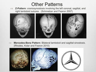 Other Patterns
 Z-Pattern: craniosynostosis involving the left coronal, sagittal, and
right lambdoid sutures . (Schmelzer and Fearon 2007)
 Mercedes-Benz Pattern: Bilateral lambdoid and sagittal sinostosis.
(Rhodes, Kolar and Fearon 2010)
 