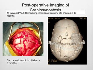 Post-operative Imaging of
Craniosynostosis
1) Calvarial Vault Remodeling : traditional surgery, old children (> 6
months)
Can be endoscopic in children <
6 months
 