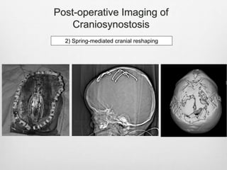 Post-operative Imaging of
Craniosynostosis
2) Spring-mediated cranial reshaping
 