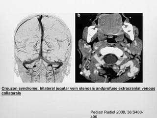 Pediatr Radiol 2008, 38:S488-
Crouzon syndrome: bilateral jugular vein stenosis andprofuse extracranial venous
collaterals
 