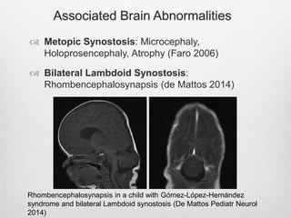 Associated Brain Abnormalities
 Metopic Synostosis: Microcephaly,
Holoprosencephaly, Atrophy (Faro 2006)
 Bilateral Lambdoid Synostosis:
Rhombencephalosynapsis (de Mattos 2014)
Rhombencephalosynapsis in a child with Gómez-López-Hernández
syndrome and bilateral Lambdoid synostosis (De Mattos Pediatr Neurol
2014)
 