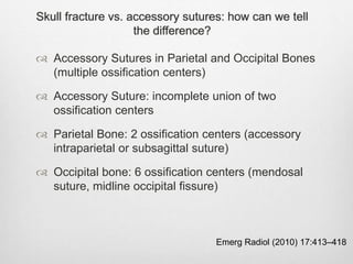 Skull fracture vs. accessory sutures: how can we tell
the difference?
Emerg Radiol (2010) 17:413–418
 Accessory Sutures in Parietal and Occipital Bones
(multiple ossification centers)
 Accessory Suture: incomplete union of two
ossification centers
 Parietal Bone: 2 ossification centers (accessory
intraparietal or subsagittal suture)
 Occipital bone: 6 ossification centers (mendosal
suture, midline occipital fissure)
 