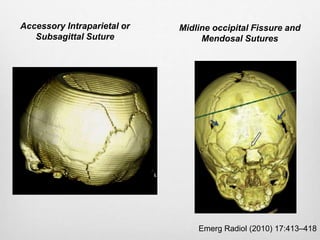 Emerg Radiol (2010) 17:413–418
Accessory Intraparietal or
Subsagittal Suture
Midline occipital Fissure and
Mendosal Sutures
 