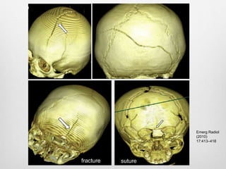 fracture suture
Emerg Radiol
(2010)
17:413–418
 