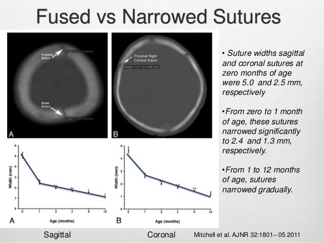 A Radiological Approach to Craniosynostosis
