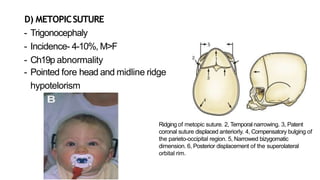 Metopic Ridge Radiopaedia Craniosynostosis | PPTX
