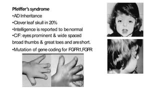 Craniosynostosis | PPTX