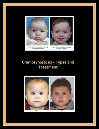Craniosynostosis - Types and 
Treatment 
 