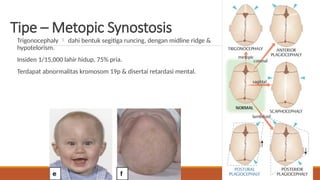 Bentuk Ridge Craniosynostosis treatment and diagnostic.pptx