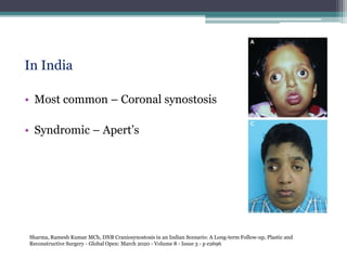 In India
• Most common – Coronal synostosis
• Syndromic – Apert’s
Sharma, Ramesh Kumar MCh, DNB Craniosynostosis in an Indian Scenario: A Long-term Follow-up, Plastic and
Reconstructive Surgery - Global Open: March 2020 - Volume 8 - Issue 3 - p e2696
 