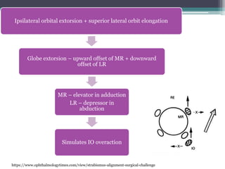 Ipsilateral orbital extorsion + superior lateral orbit elongation
Globe extorsion – upward offset of MR + downward
offset of LR
MR – elevator in adduction
LR – depressor in
abduction
Simulates IO overaction
https://www.ophthalmologytimes.com/view/strabismus-alignment-surgical-challenge
 