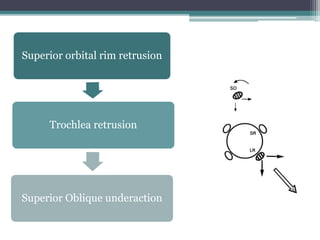 Superior orbital rim retrusion
Trochlea retrusion
Superior Oblique underaction
 