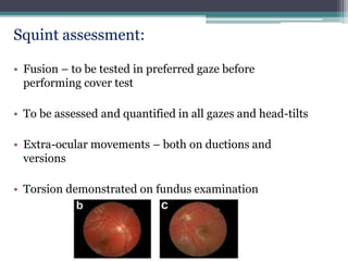 Squint assessment:
• Fusion – to be tested in preferred gaze before
performing cover test
• To be assessed and quantified in all gazes and head-tilts
• Extra-ocular movements – both on ductions and
versions
• Torsion demonstrated on fundus examination
 