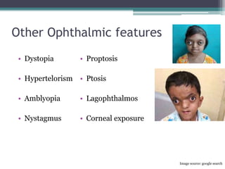 Other Ophthalmic features
• Dystopia
• Hypertelorism
• Amblyopia
• Nystagmus
• Proptosis
• Ptosis
• Lagophthalmos
• Corneal exposure
Image source: google search
 