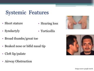 • Short stature
• Syndactyly
• Broad thumbs/great toe
• Beaked nose or bifid nasal tip
• Cleft lip/palate
• Airway Obstruction
• Hearing loss
• Torticollis
Image source: google search
Systemic Features
 