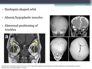 • Harlequin shaped orbit
• Absent/hypoplastic muscles
• Abnormal positioning of
trochlea
Abdelrahman M. Elhusseiny, Elisah M. Huynh & Linda R. Dagi (2020) Evaluation and Management of V pattern Strabismus in Craniosynostosis, Journal of
Binocular Vision and Ocular Motility, 70:1, 40-45
 