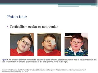 Patch test:
• Torticollis – ocular or non-ocular
Abdelrahman M. Elhusseiny, Elisah M. Huynh & Linda R. Dagi (2020) Evaluation and Management of V pattern Strabismus in Craniosynostosis, Journal of
Binocular Vision and Ocular Motility, 70:1, 40-45
 