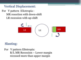 For V pattern EXotropia :
MR resection with down-shift
LR recession with up-shift
MR
LR LE
For V pattern ESotropia:
B/L MR Recession – Lower margin
recessed more than upper margin
Vertical Displacement:
Slanting:
 