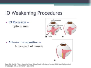 IO Weakening Procedures
• IO Recession –
upto 14 mm
• Anterior transposition –
Alters path of muscle
Stager D Jr, Dao LM, Felius J. Uses of the Inferior Oblique Muscle in Strabismus Surgery. Middle East Afr J Ophthalmol.
2015;22(3):292-297. doi:10.4103/0974-9233.159723
 