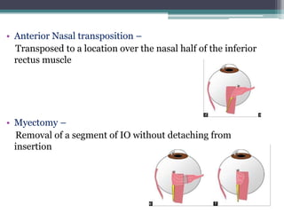 • Anterior Nasal transposition –
Transposed to a location over the nasal half of the inferior
rectus muscle
• Myectomy –
Removal of a segment of IO without detaching from
insertion
 