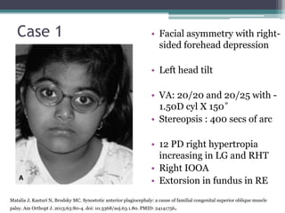 Case 1
• 6 year old
• Uneventful perinatal and
developmental history
• Tilting of head to watch
TV
• Using glasses and had
undergone amblyopia
therapy
• Facial asymmetry with right-
sided forehead depression
• Left head tilt
• VA: 20/20 and 20/25 with -
1.50D cyl X 150˚
• Stereopsis : 400 secs of arc
• 12 PD right hypertropia
increasing in LG and RHT
• Right IOOA
• Extorsion in fundus in RE
Matalia J, Kasturi N, Brodsky MC. Synostotic anterior plagiocephaly: a cause of familial congenital superior oblique muscle
palsy. Am Orthopt J. 2013;63:80-4. doi: 10.3368/aoj.63.1.80. PMID: 24141756.
 