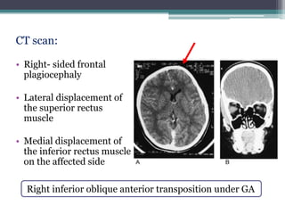 CT scan:
• Right- sided frontal
plagiocephaly
• Lateral displacement of
the superior rectus
muscle
• Medial displacement of
the inferior rectus muscle
on the affected side
Right inferior oblique anterior transposition under GA
 