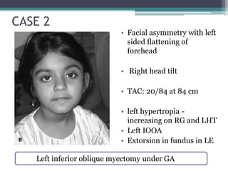 CASE 2
• 2 year old
• Uneventful perinatal and
developmental history
• Head tilt to right since 1
year
• Facial asymmetry with left
sided flattening of
forehead
• Right head tilt
• TAC: 20/84 at 84 cm
• left hypertropia -
increasing on RG and LHT
• Left IOOA
• Extorsion in fundus in LE
Left inferior oblique myectomy under GA
 