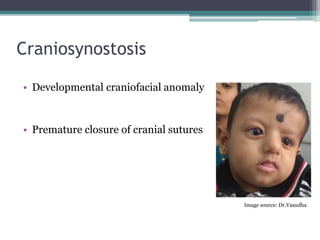 Craniosynostosis
• Developmental craniofacial anomaly
• Premature closure of cranial sutures
Image source: Dr.Vasudha
 