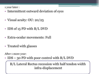 1 year later :
• Intermittent outward deviation of eyes
• Visual acuity: OU: 20/25
• IDS of 15 PD with B/L DVD
• Extra-ocular movements: Full
• Treated with glasses
After 1 more year:
• IDS – 30 PD with poor control with B/L DVD
B/L Lateral Rectus recession with half tendon width
infra-displacement
 