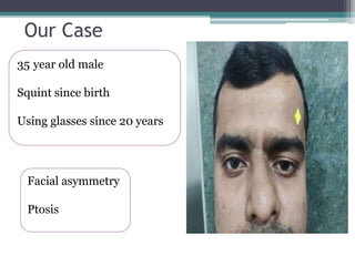 Our Case
35 year old male
Squint since birth
Using glasses since 20 years
Facial asymmetry
Ptosis
 
