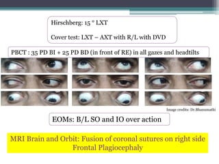 Image credits: Dr.Bhanumathi
Hirschberg: 15 ° LXT
Cover test: LXT – AXT with R/L with DVD
PBCT : 35 PD BI + 25 PD BD (in front of RE) in all gazes and headtilts
EOMs: B/L SO and IO over action
MRI Brain and Orbit: Fusion of coronal sutures on right side
Frontal Plagiocephaly
 