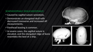 Sadgital Ridge Craniosynostosis Chiari Dandy walker malformation | PPTX