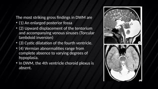 Craniosynostosis Chiari Dandy walker malformation | PPTX