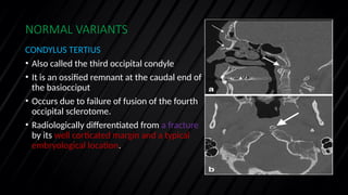 Craniosynostosis Chiari Dandy walker malformation | PPTX