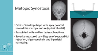 Metopic Ridge Radiopaedia Craniosynostosis in children and management | PPTX
