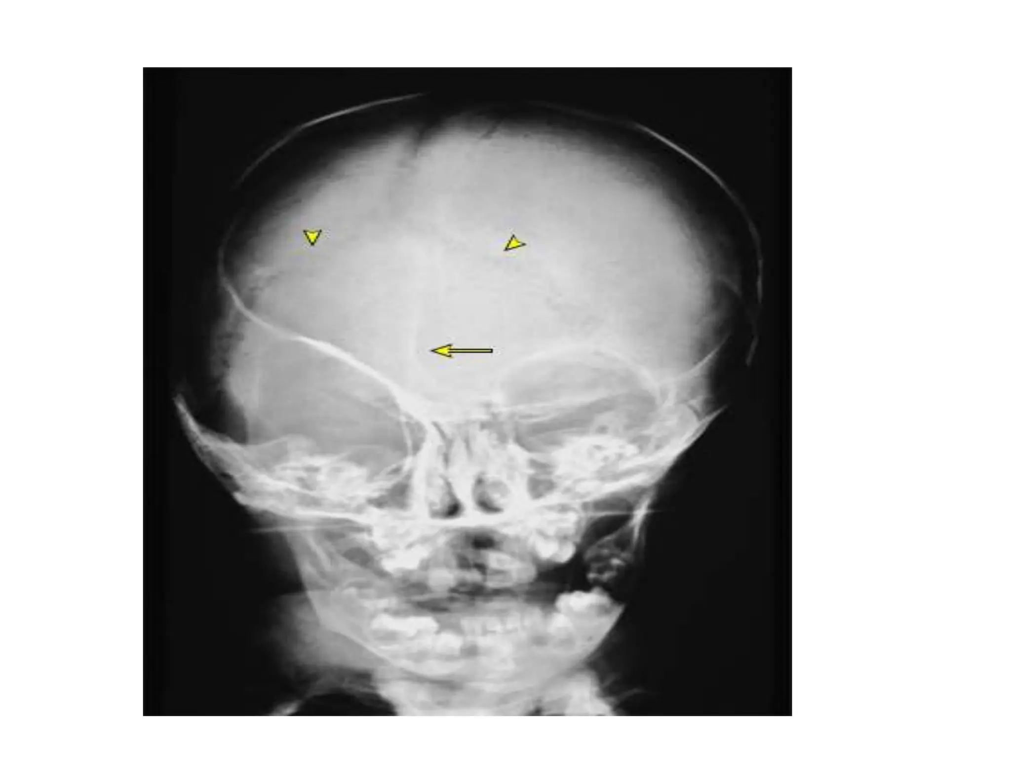 Craniosynostosis Syndromes pptx PPT craniosynostosis-syndromes-pptx-ppt