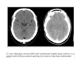Craniotomy for brain tumour | PPTX