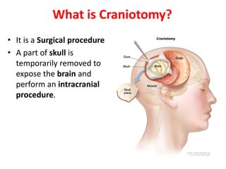 What is Craniotomy?
• It is a Surgical procedure
• A part of skull is
temporarily removed to
expose the brain and
perform an intracranial
procedure.
 