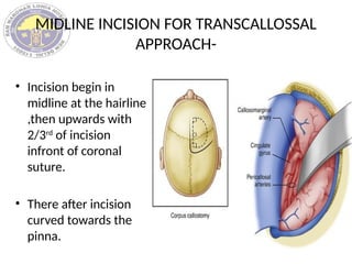 Complete Midline Incision CRANIOTOMY FLAPS ,INCISION AND CLOSURE.pptx