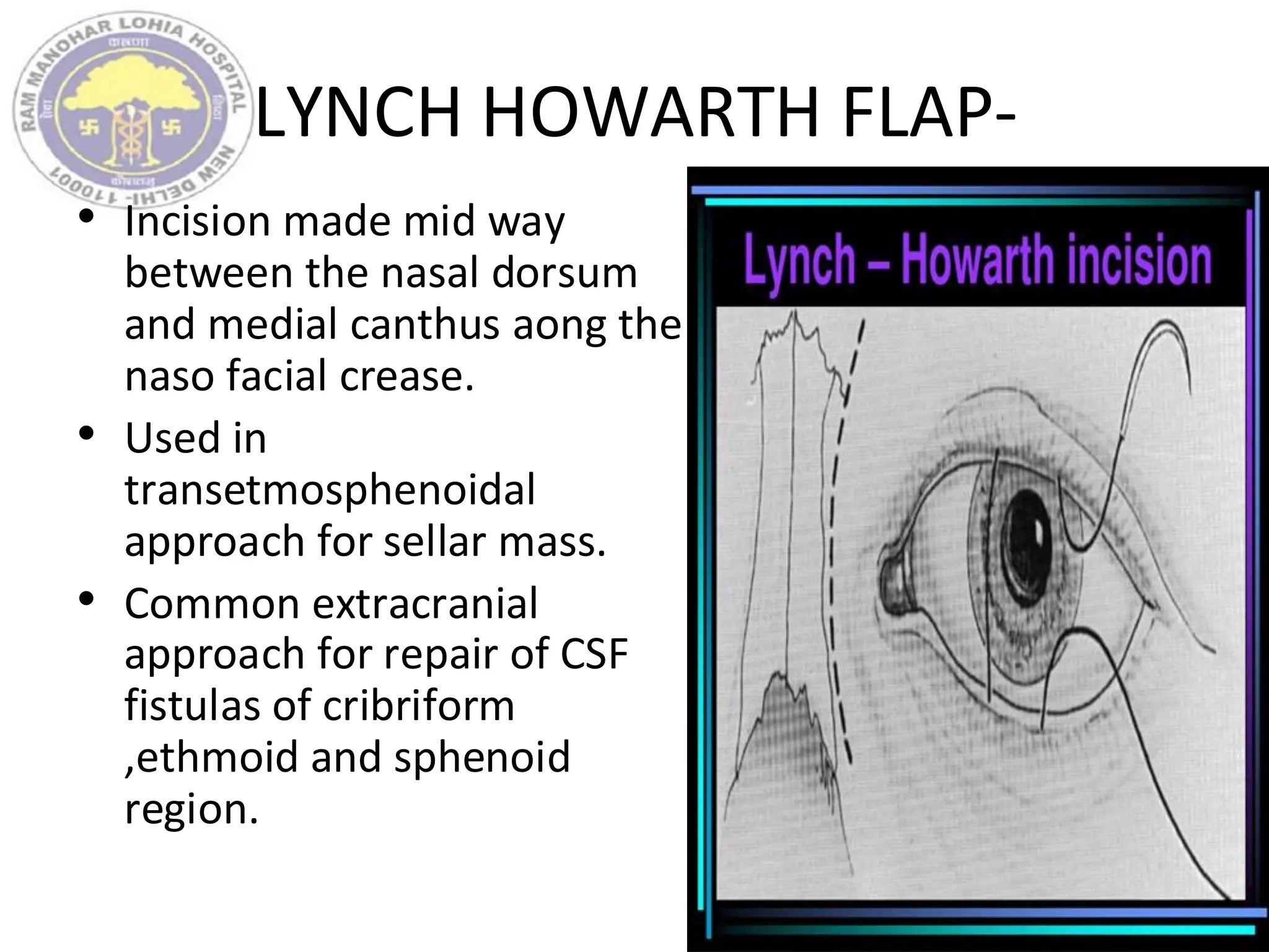 LYNCH HOWARTH FLAP-
• Incision made mid way
between the nasal dorsum
and medial canthus aong the
naso facial crease.
• Used in
transetmosphenoidal
approach for sellar mass.
• Common extracranial
approach for repair of CSF
fistulas of cribriform
,ethmoid and sphenoid
region.
 