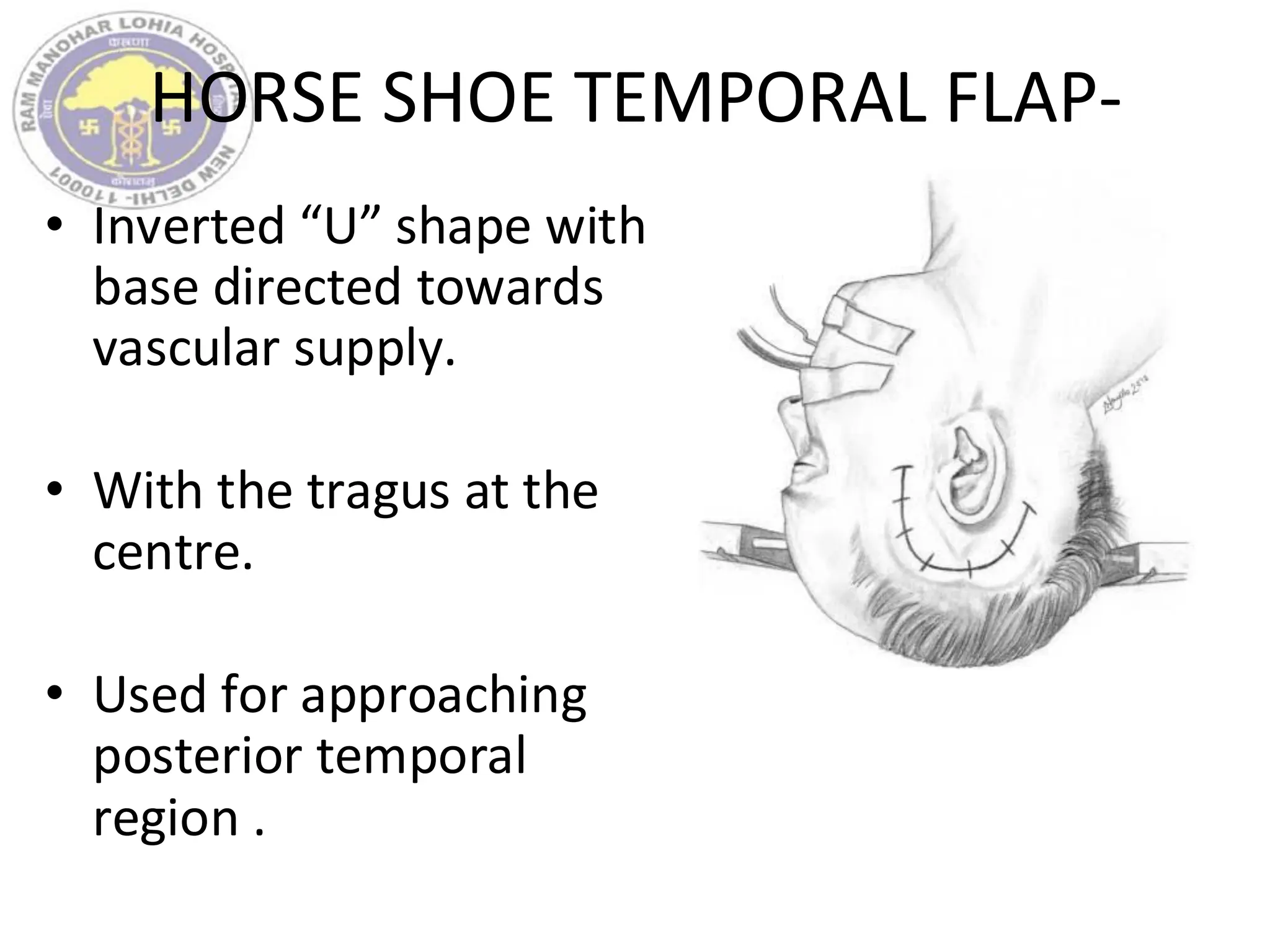 HORSE SHOE TEMPORAL FLAP-
• Inverted “U” shape with
base directed towards
vascular supply.
• With the tragus at the
centre.
• Used for approaching
posterior temporal
region .
 