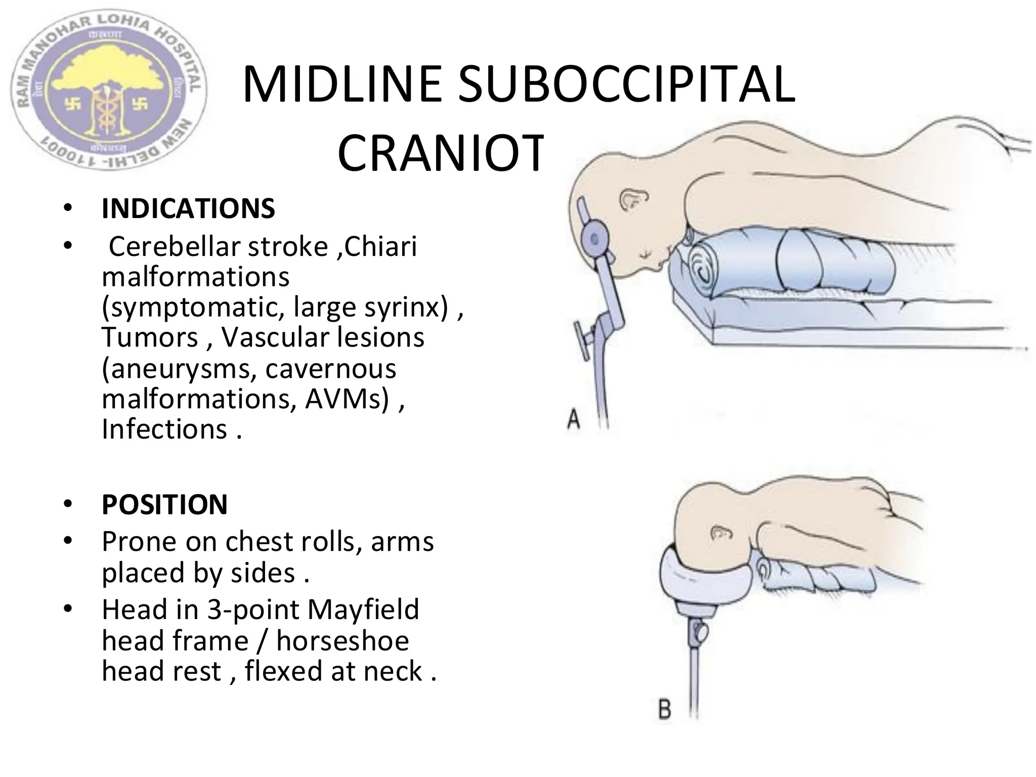 MIDLINE SUBOCCIPITAL
CRANIOTOMY--
• INDICATIONS
• Cerebellar stroke ,Chiari
malformations
(symptomatic, large syrinx) ,
Tumors , Vascular lesions
(aneurysms, cavernous
malformations, AVMs) ,
Infections .
• POSITION
• Prone on chest rolls, arms
placed by sides .
• Head in 3-point Mayfield
head frame / horseshoe
head rest , flexed at neck .
 