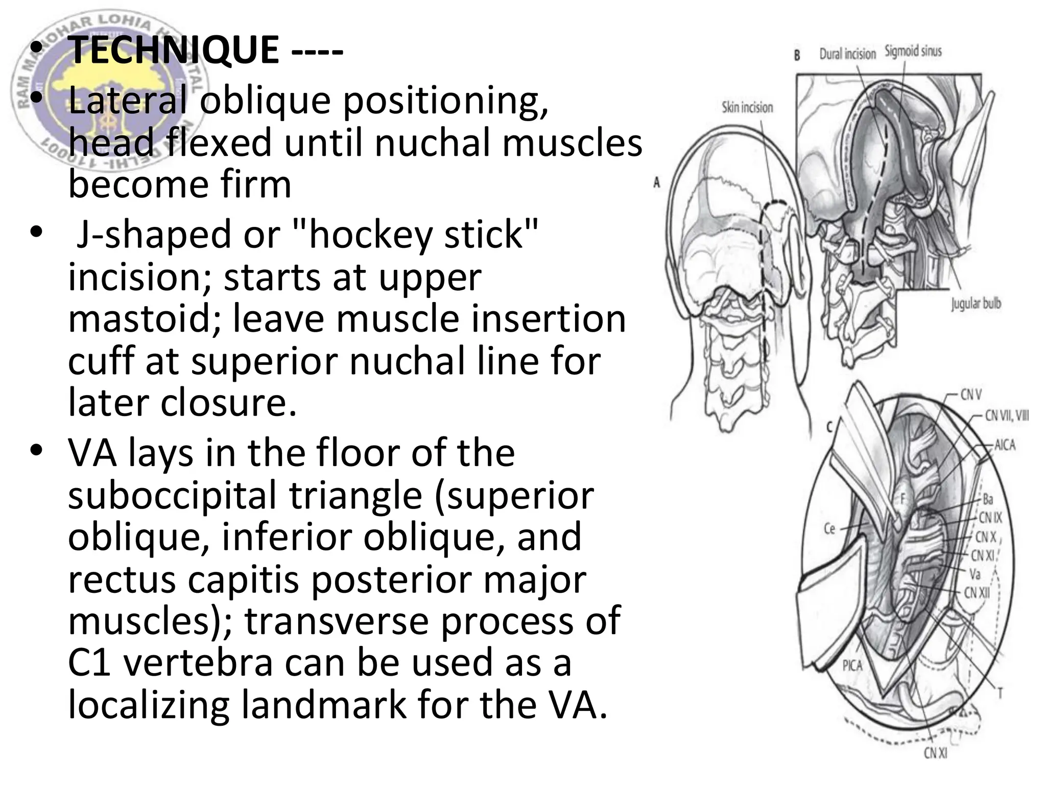 • TECHNIQUE ----
• Lateral oblique positioning,
head flexed until nuchal muscles
become firm
• J-shaped or "hockey stick"
incision; starts at upper
mastoid; leave muscle insertion
cuff at superior nuchal line for
later closure.
• VA lays in the floor of the
suboccipital triangle (superior
oblique, inferior oblique, and
rectus capitis posterior major
muscles); transverse process of
C1 vertebra can be used as a
localizing landmark for the VA.
 