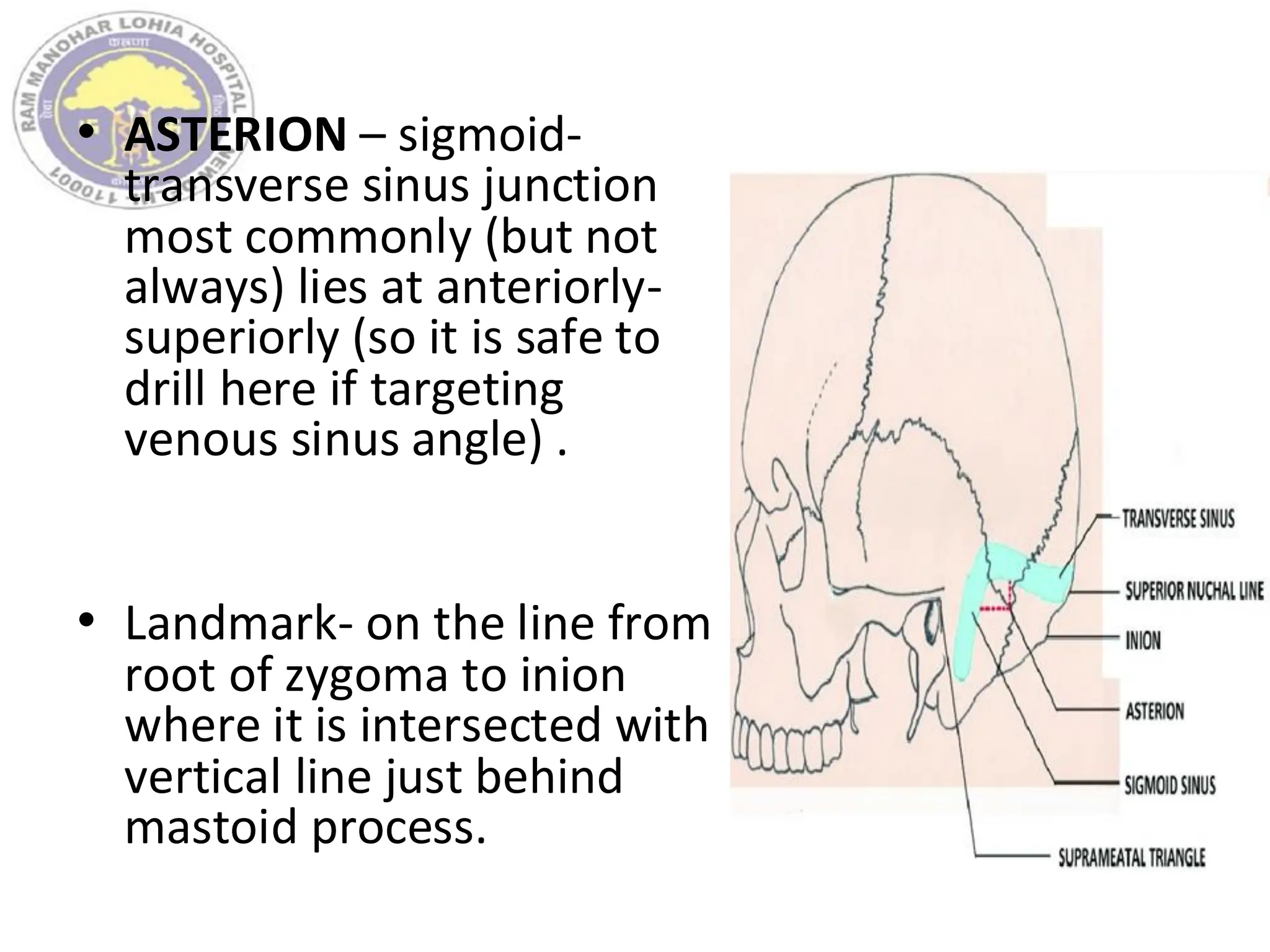 • ASTERION – sigmoid-
transverse sinus junction
most commonly (but not
always) lies at anteriorly-
superiorly (so it is safe to
drill here if targeting
venous sinus angle) .
• Landmark- on the line from
root of zygoma to inion
where it is intersected with
vertical line just behind
mastoid process.
 