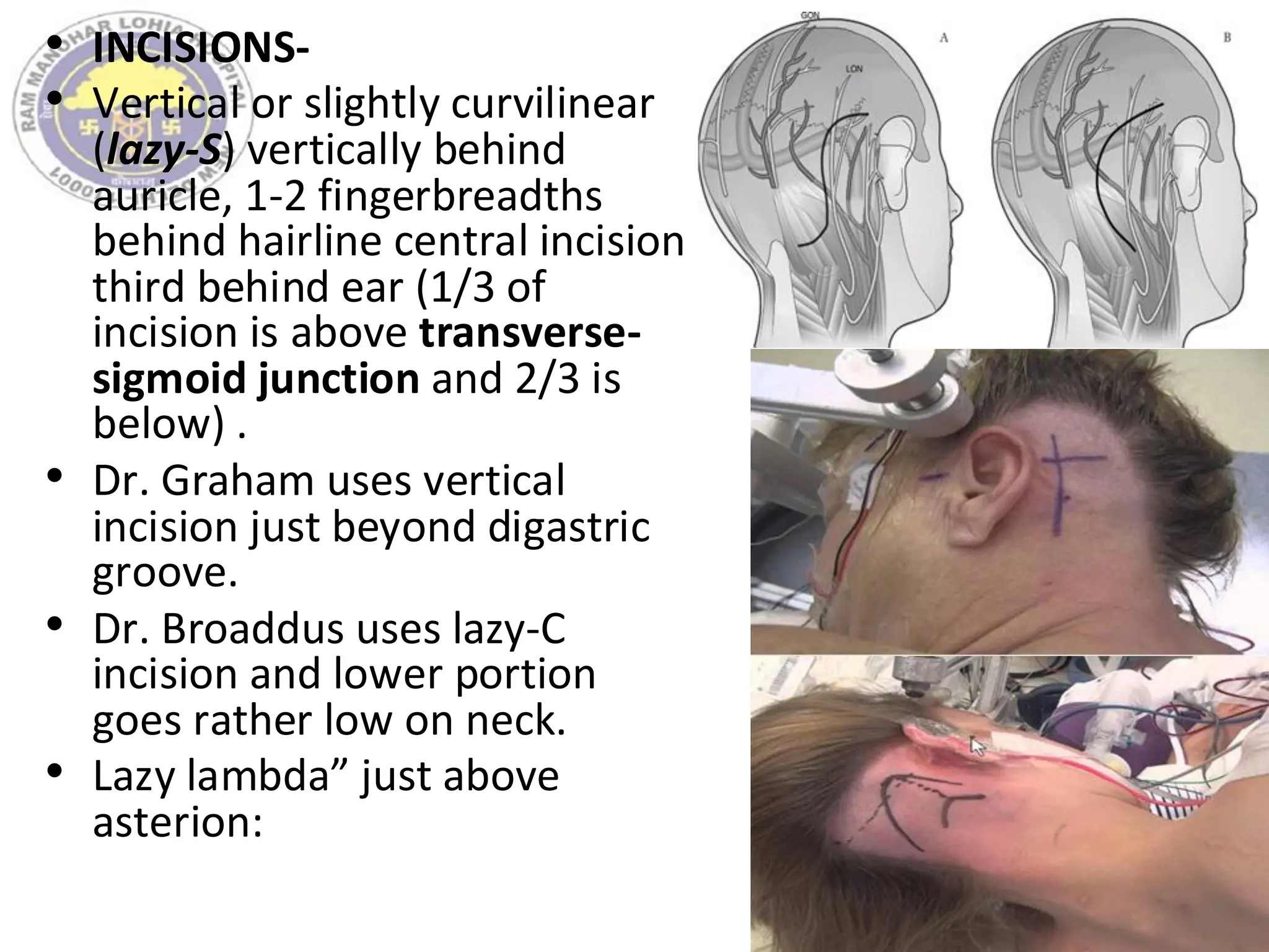 • INCISIONS-
• Vertical or slightly curvilinear
(lazy-S) vertically behind
auricle, 1-2 fingerbreadths
behind hairline central incision
third behind ear (1/3 of
incision is above transverse-
sigmoid junction and 2/3 is
below) .
• Dr. Graham uses vertical
incision just beyond digastric
groove.
• Dr. Broaddus uses lazy-C
incision and lower portion
goes rather low on neck.
• Lazy lambda” just above
asterion:
 