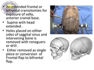 • An extended frontal or
bifrontal craniotomies for
exposure of sella,
anterior cranial base.
• Supine with head
extended .
• Holes placed on either
sides of saggital sinus and
intervening bone is
removed with roneguers
or drill .
• Either removed as single
piece or conversion of
Frontal flap to bifrontal
flap.
 