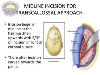 MIDLINE INCISION FOR
TRANSCALLOSSAL APPROACH-
• Incision begin in
midline at the
hairline ,then
upwards with 2/3rd
of incision infront of
coronal suture.
• There after incision
curved towards the
pinna.
 